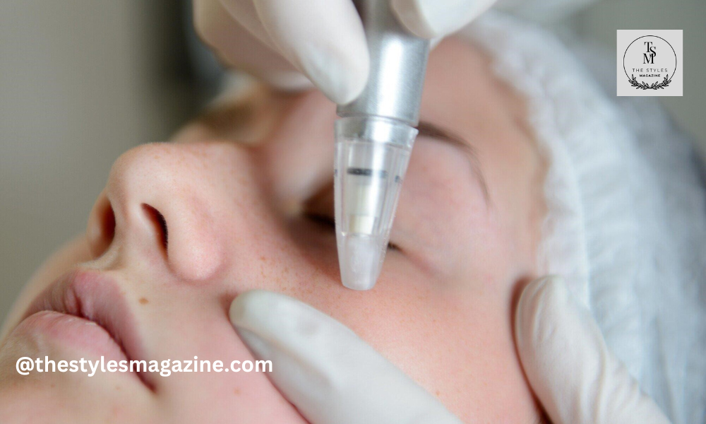 microneedling treatment