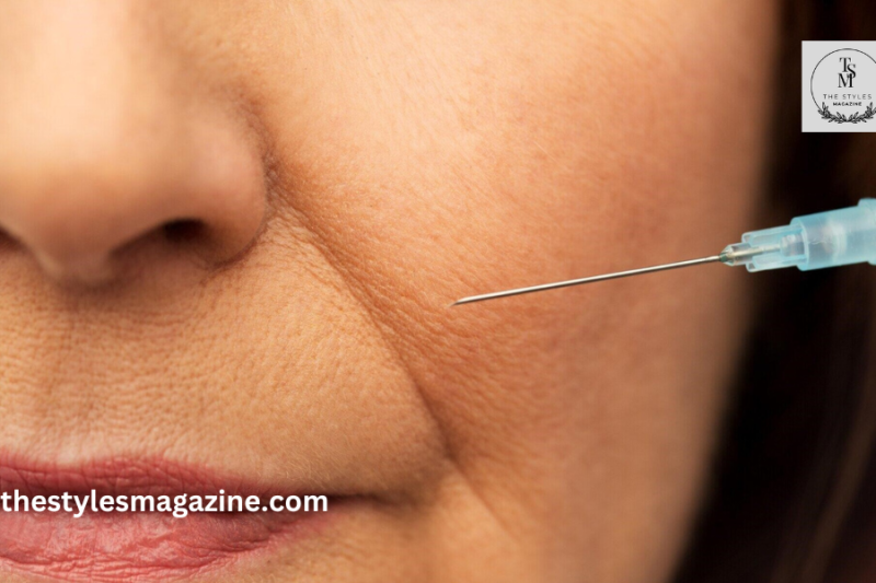 How Smile Line Botox Can Transform Your Look