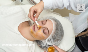 chemical peel for acne